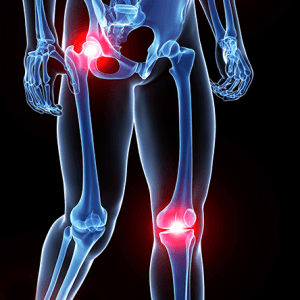 Hip & Knee Roundtable: Arthritis, Replacements, and Everything in between